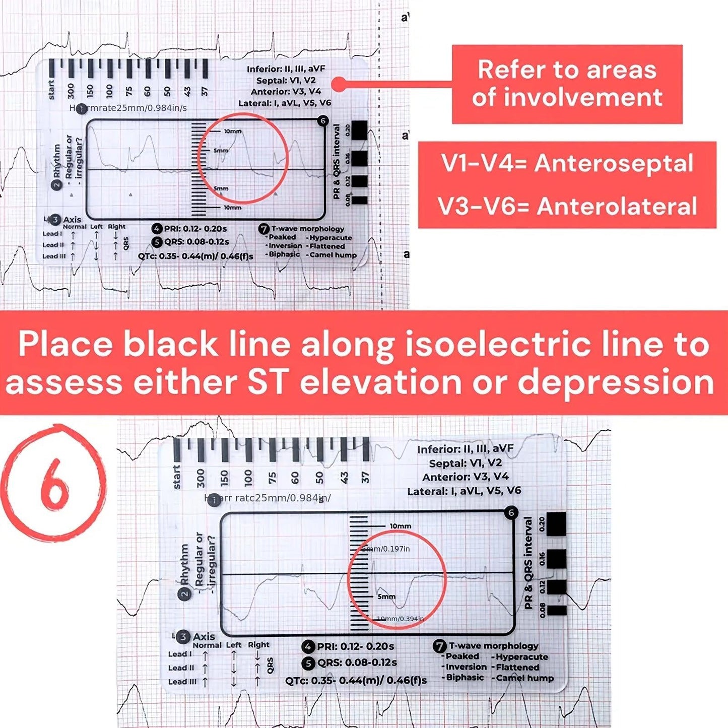 ECG 7 Step Ruler, ECG Ruler Plastic Ruler Measuring Tool, ECG 7 Step Ruler for ECG/EKG Interpretation, Transparent ECG Calipers Measuring Tool, Easy to Carry ECG Ruler, Follow 7 Step Plan (1pc)